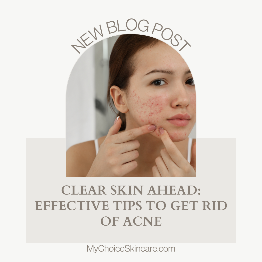 Discover the ultimate guide to combat acne and achieve clear, glowing skin! Uncover effective strategies, skincare tips, and lifestyle changes to get rid of acne for good. Say goodbye to breakouts and hello to confidence! 🌟💫