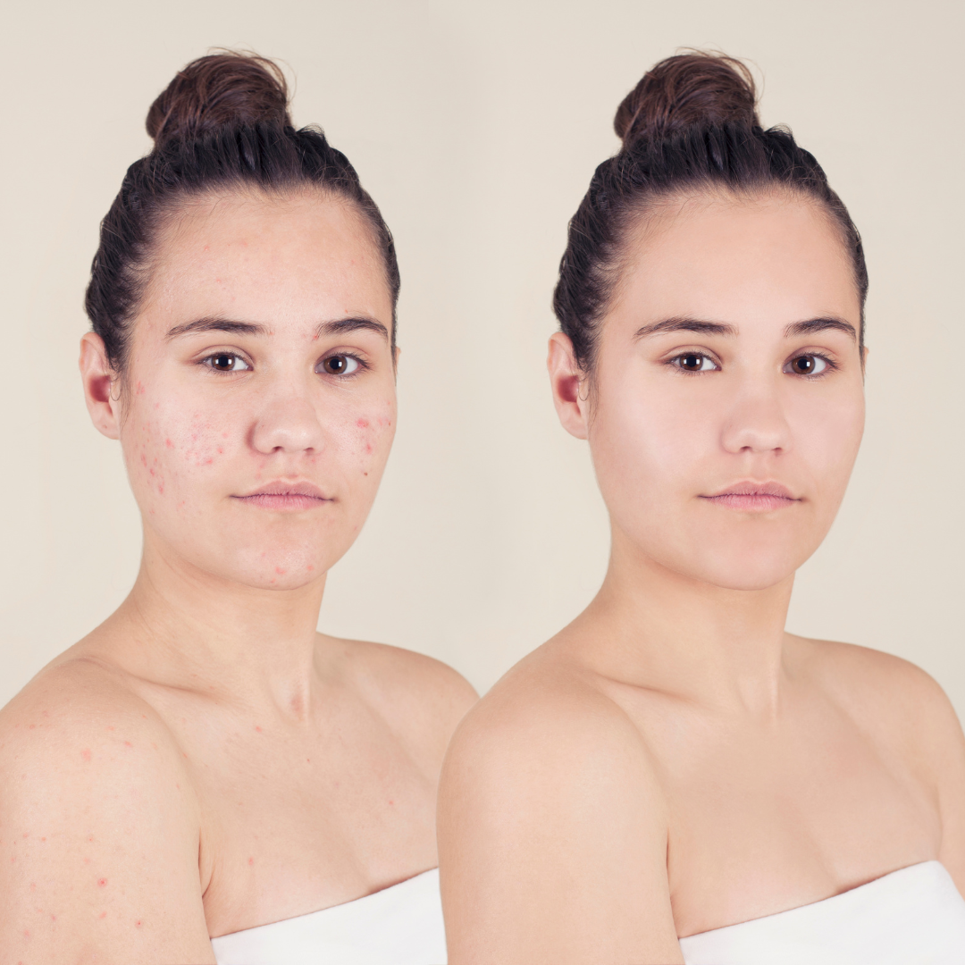 Your Skin Care Guide for Reducing Acne and Breakouts