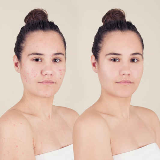 Your Skin Care Guide for Reducing Acne and Breakouts