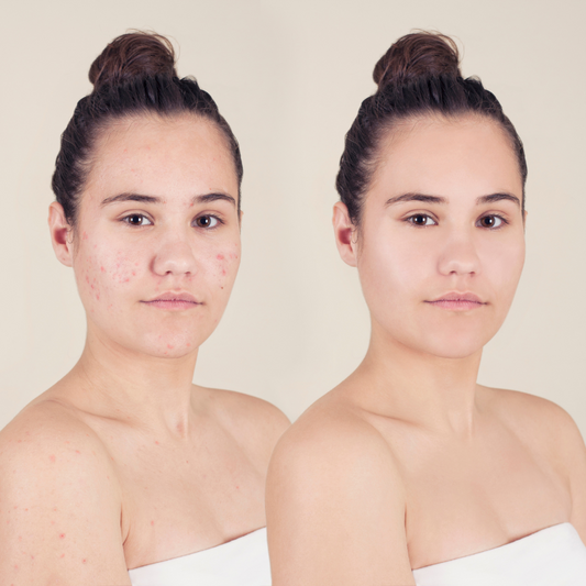 A Comprehensive Skin Care Guide for Acne and Breakouts